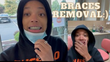 Braces Removal from 4 years AGO!!!