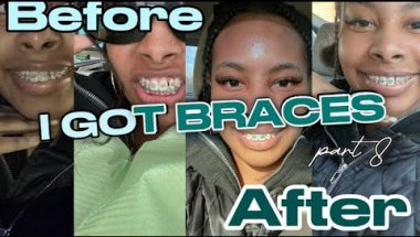 I GOT BRACES!! Part 8 | Composite Bonding + Color change | Brya Life