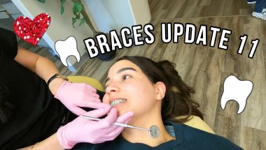 Braces Update 11 🦷 (Completing 11 months with braces + Dental Cleaning + x-rays)