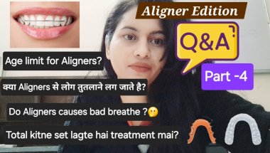 Aligners Q n A Part 4 🤐|सवाल-जवाब|#aligners​​​ #braces​​​ #dentalcare​​​ #smilemakeover​​​ #teeth​​​