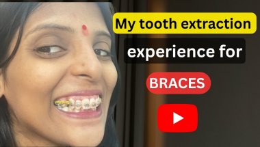 My tooth extraction experience for braces😬| दांत निकलवाने में कितना दर्द हुआ 😭