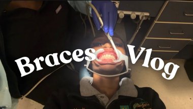 I GOT BRACES 🫣 (ONLY GOT MY TOP DONE FIRST) | LifeWithVanity