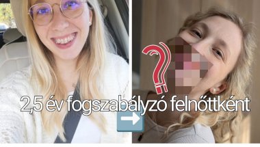 Végre lekerült :) - fogszabályzó felnőttként #eredmény