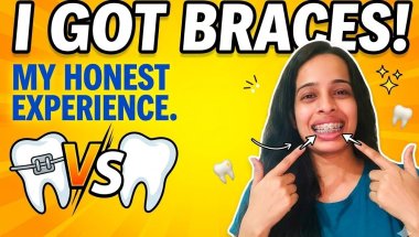 Honest Update: What nobody tells you about life with wires 🔩🤔#BracesJourney #SmileTransformation