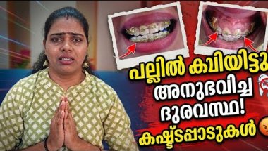 Braces ഇടാൻ പോകുന്നവർ ഇതൊന്ന് കണ്ടു നോക്കൂ! എന്റെ അനുഭവം. മൂന്നുതവണയാണ് കമ്പി ഇടേണ്ടി വന്നത് 🥹🦷🦷🦷😖😡😫
