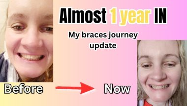 Almost 1 year IN 🥳 #metalbraces #braces #smile #walkandtalk #orthodontics