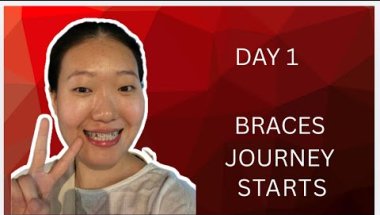Day 1 With Braces - Real story 😬| Akku Nisso 🌷