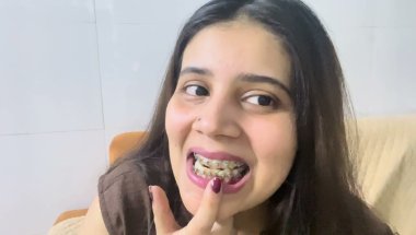 Braces lgane ke baad kitne din me teeth aliments me aane lagte hai#viral #dentist #trending #youtube