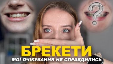 ПОСТАВИЛА БРЕКЕТИ | Перші відчуття та очікування | ALINA VIBES