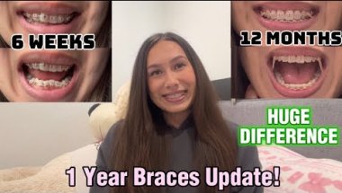 1 Year Braces Update! HUGE DIFFERENCE | 24yr Old With Braces