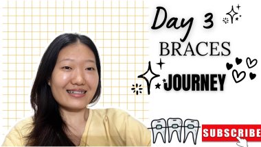Day 3 Braces Journey 😬| My experience 🥲( Real story) | Akku Nisso🌷