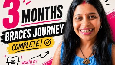 My Braces Journey (3 Months) | क्या सच में फर्क पड़ा?