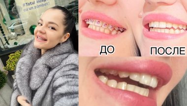 Я СНЯЛА БРЕКЕТЫ | что дальше и мои рекомендации?!