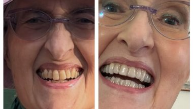 Come e andata a finire con Invisalign?