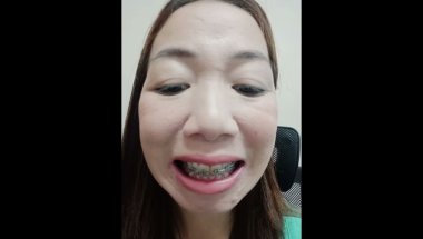 Before and After Braces