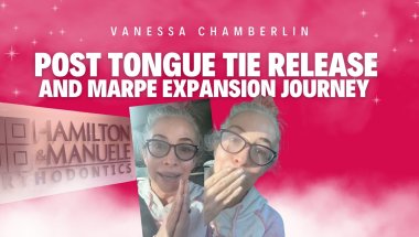 Post tongue tie release and MARPE expansion journey