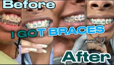 I GOT BRACES!! Part 9 | composite bonding & retighten!