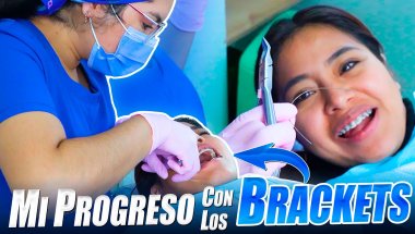 Así se ve mi sonrisa después de meses con brackets 😁Mira el cambio✨