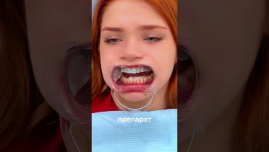 пациент после элайнеров устанавливает брекеты