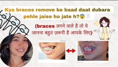 Braces ke baad daant wapas tedhe ho jaate hain? 😨 Sach kya hai!#bracesjourney#braces#bracestreatment