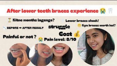 Lower Teeth Braces Experience 🦷😭 |  Mere Lower Braces Lag Gaye 😬 Pain + Cost + Before/After