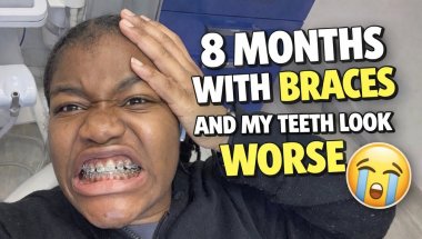 Braces is making my teeth look worse