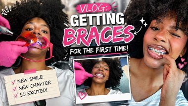 I GOT BRACES! (PREP+EXPERIENCE+PAIN LEVEL)