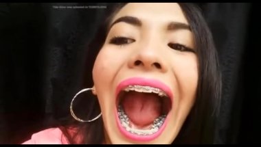 Woman With Braces Excited To Show Off Her Full Mouth Of Amalgam Fillings After Retiring From Dentist