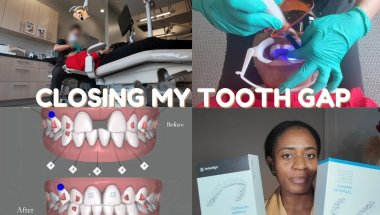 I GOT INVISALIGN! | Installation Process, What They Don’t Tell You + First Thoughts/Day 1 experience