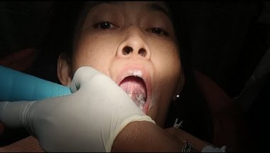 Brackets & Braces Adjustment, and Myofascial Release
