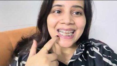 My 1 year 31 days braces update #viral #dentist #trending #youtube #dentalclinic #teeth