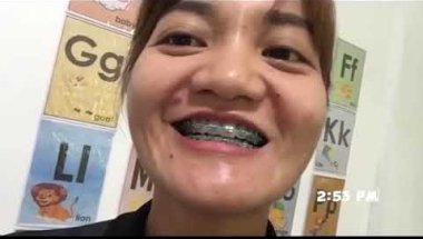 BRACES REMOVAL