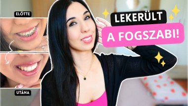 Levetettem a fogszabályzót… milyen érzés valójában? 🦷
