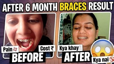 After 6 Months.. Braces result  😲😳#aaryashukla #braces #beforafter #tooth#vlog#bracestransformation