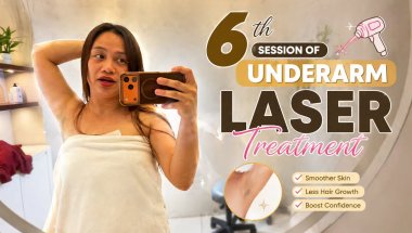 6TH SESSION OF UNDERARM DIODE LASER TREATMENT