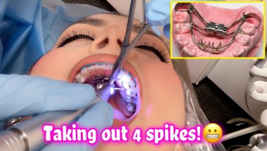 SO THIS HAPPENED AT THIS MONTHS APPOINTMENT **OUCH** #Braces