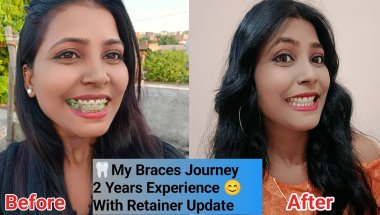 🦷2 Years Braces Experience 😍 ll ब्रेसेस लगाने का टोटल खर्च कितना है 2026 in india /all about braces