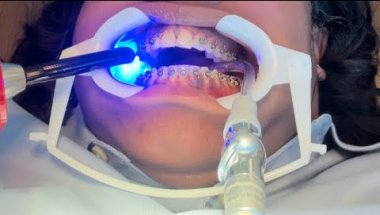 *ORTHO* Adjustment appointment 15