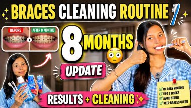 8 Months Braces Update + My Cleaning Routine 😬✨ | Real Results!
