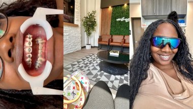 Adult Braces Journey: Gingivitis Scare 😳 Deep Gum Cleaning at Dentist & Orthodontist Visit