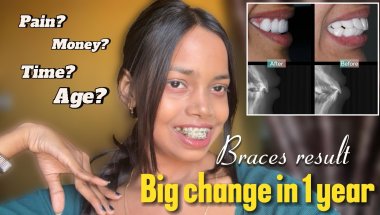 BRACES before and after 😨? Shocking result | Truth You Must Know!✅