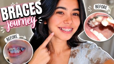 “Before Getting Braces Watch This!2026😰😭 (Full Guide + Q&A)”#braces #bracestreatment #bracesjourney