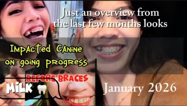 My braces journey in 2 years | Trust the process with your orthodontist | impacted tooth progress