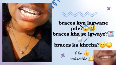 मेरी Braces Journey शुरू हो गई!😬😱 Braces क्यों लगवाना पड़ा?😭