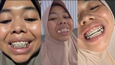 Menjawab pertanyaan keluarga online tentang pemasangan behel