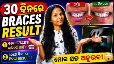 30 ଦିନର brace's🦷 result | ଆପଣ ମାନଙ୍କ ପ୍ରଶ୍ନ? ର ଉତ୍ତର |siluvlog|