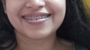 Honest details about 11days braces journey....
