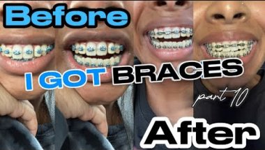 I GOT BRACES!! Part 10 | Powerchains and rubberbands | Brya Life