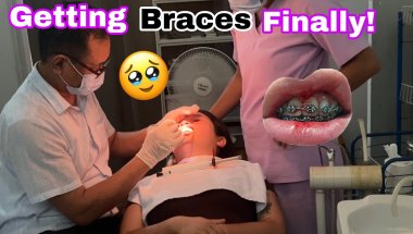 I GOT BRACES 🦷!! FOR THE FIRST TIME (MY EXPERIENCE + PAIN