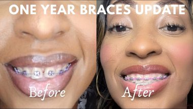 ONE YEAR BRACES UPDATE… was it worth it?